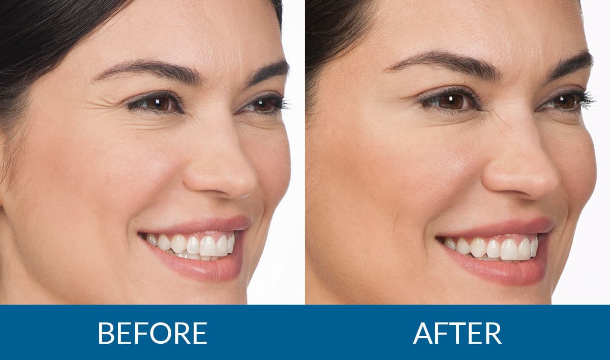 Botox before and after — Cynthia