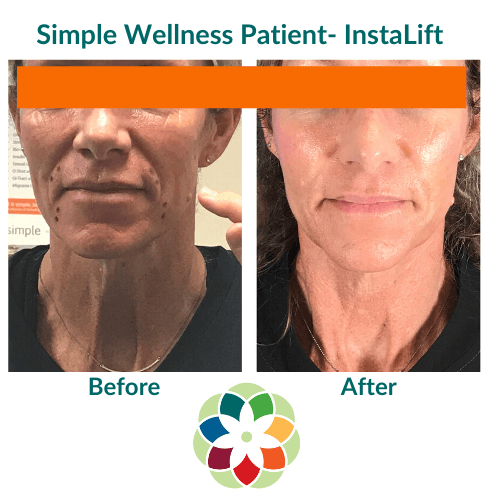 InstaLift before and after